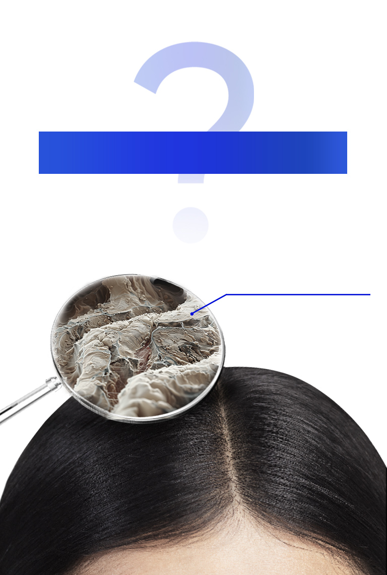 以為洗乾淨 頭屑還是反覆出現